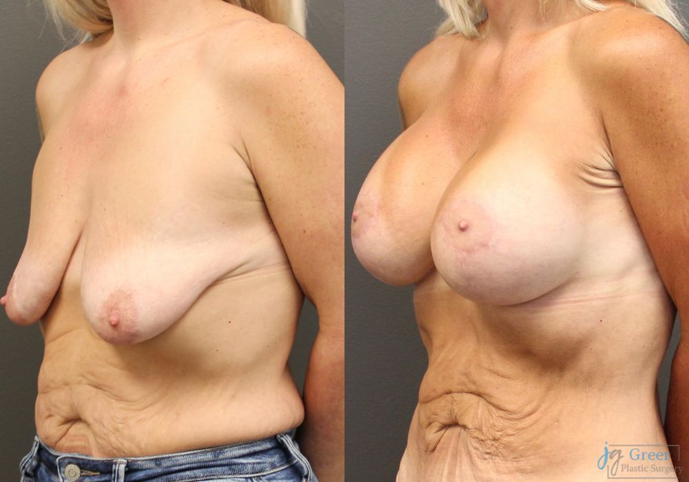 Breast Augmentation with Lift - Thumbnail 2