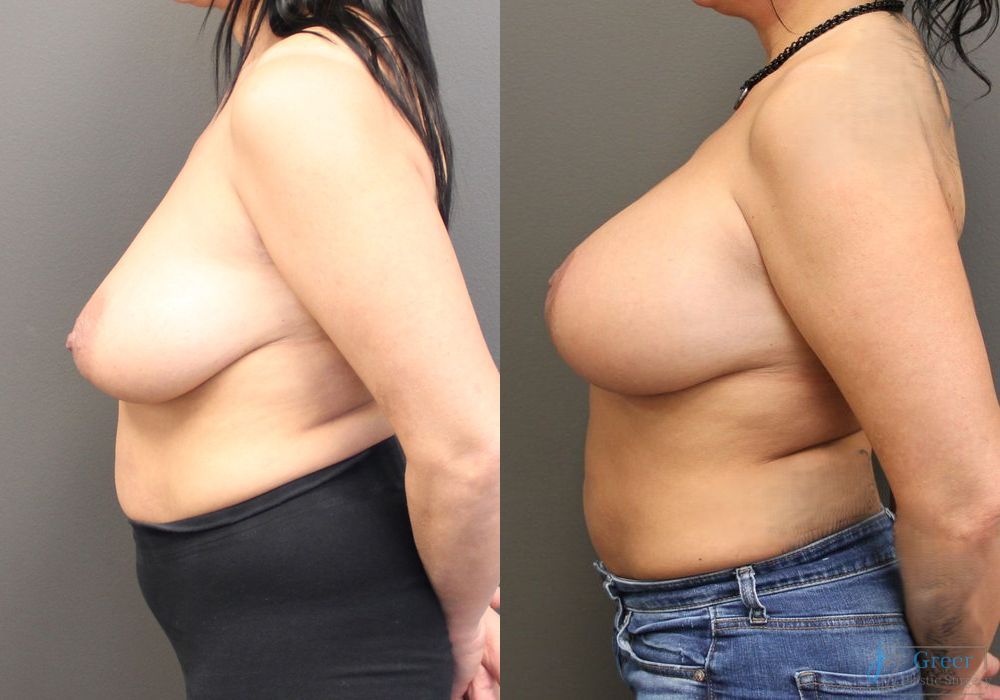 Breast Augmentation with Lift - Thumbnail 2