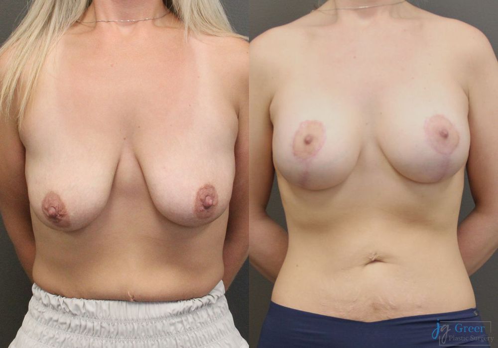 Breast Augmentation with Lift - Case 2368