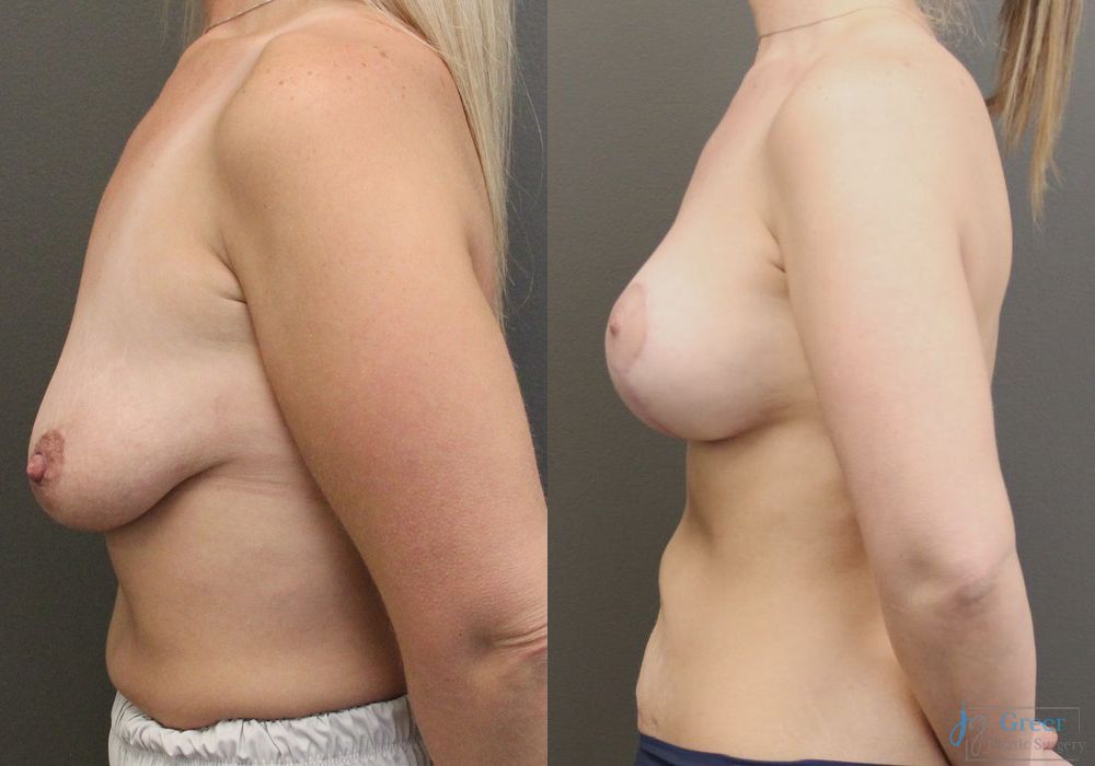 Breast Augmentation with Lift - Thumbnail 2