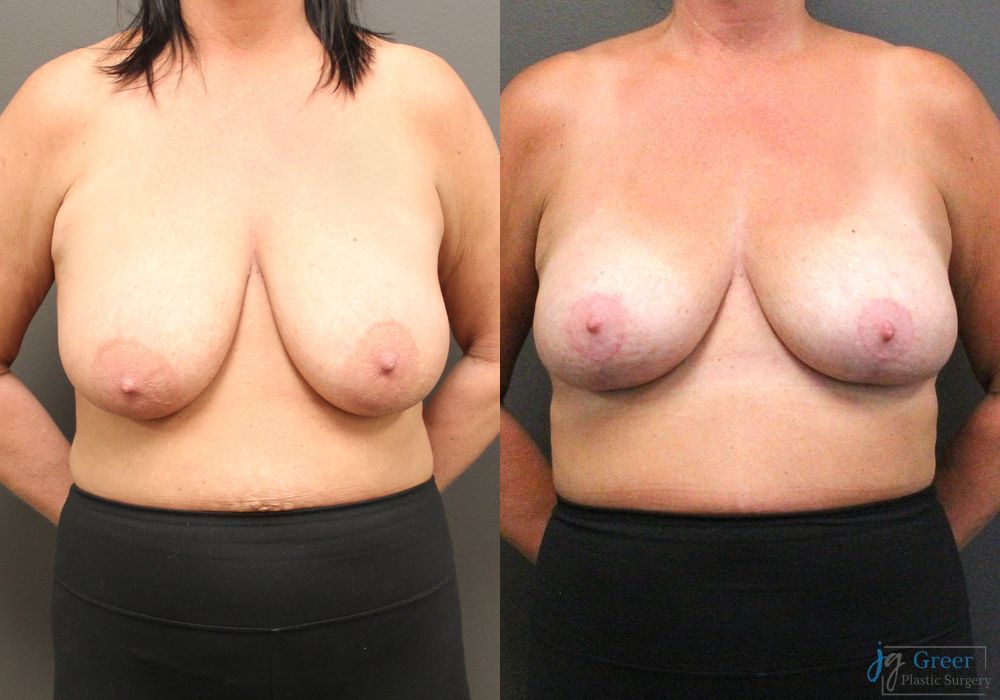 Breast Reduction - Case 2381