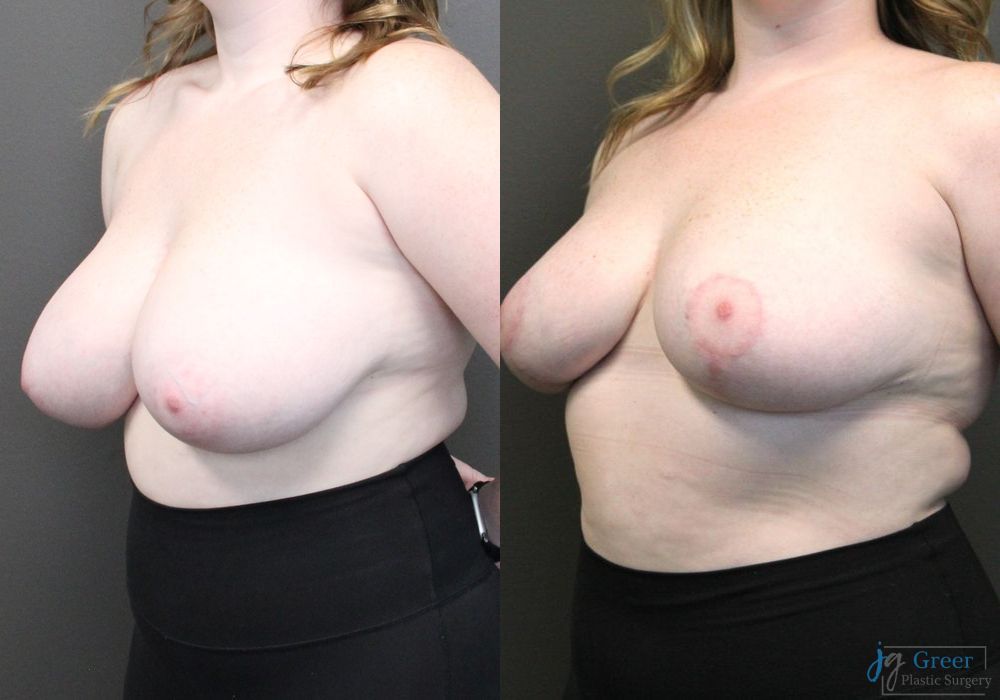 Breast Reduction - Thumbnail 2