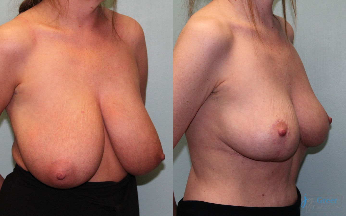 Before and after Breast Reduction case 19804 - Angle 2