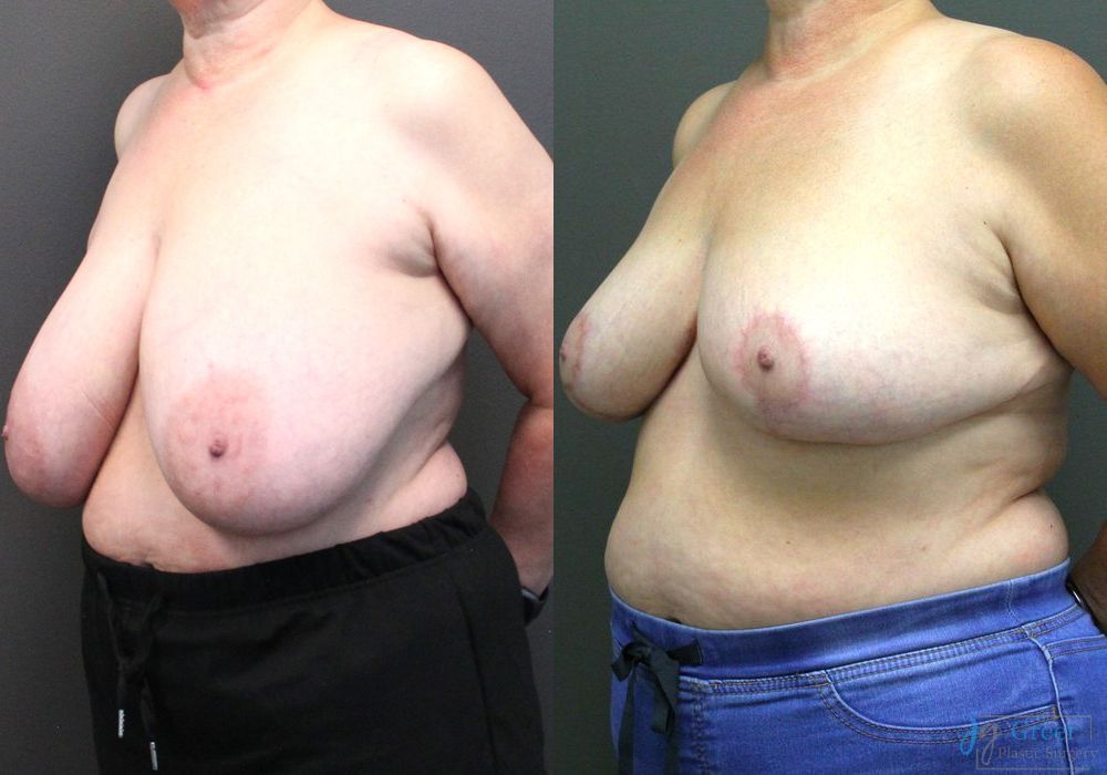 Breast Reduction - Thumbnail 2