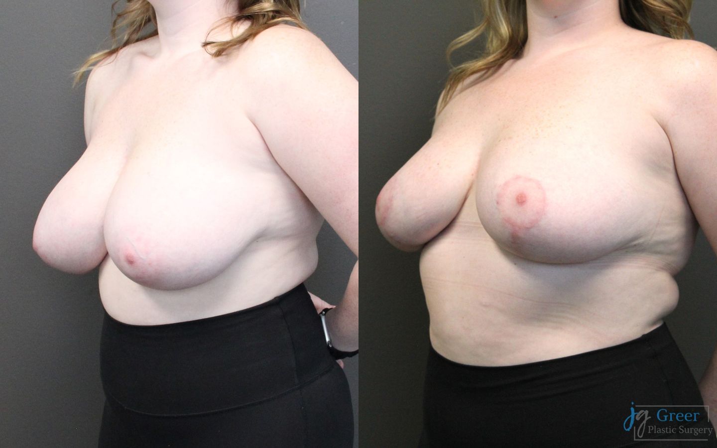 Before and after Breast Reduction case 19791 - Angle 2