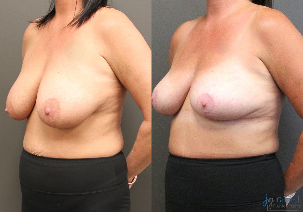 Breast Reduction - Thumbnail 2