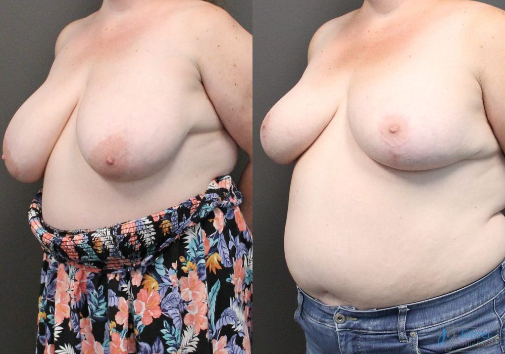 Breast Reduction - Thumbnail 2