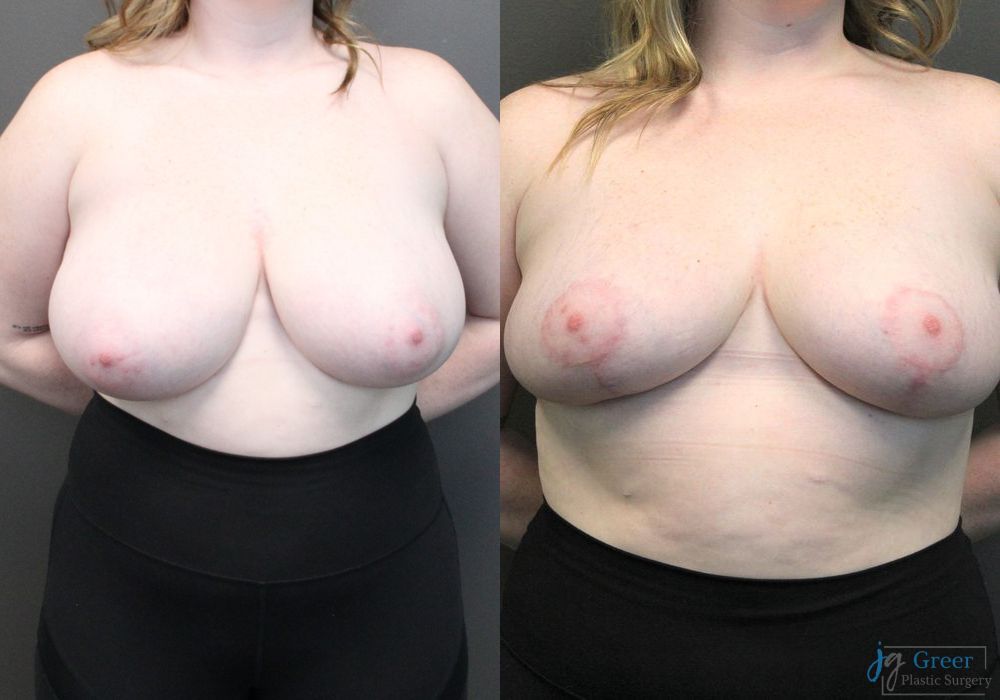 Breast Reduction - Case 2370