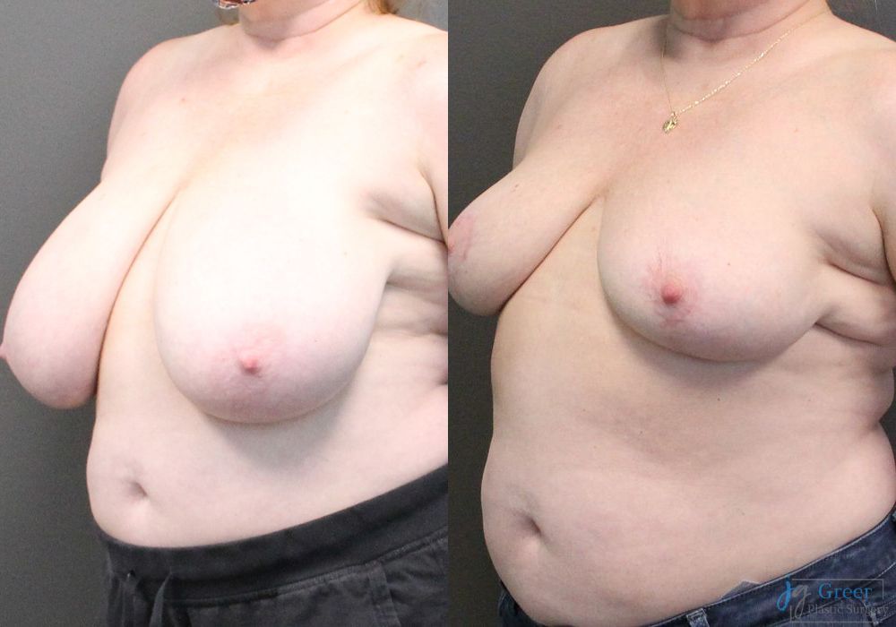 Breast Reduction - Thumbnail 2