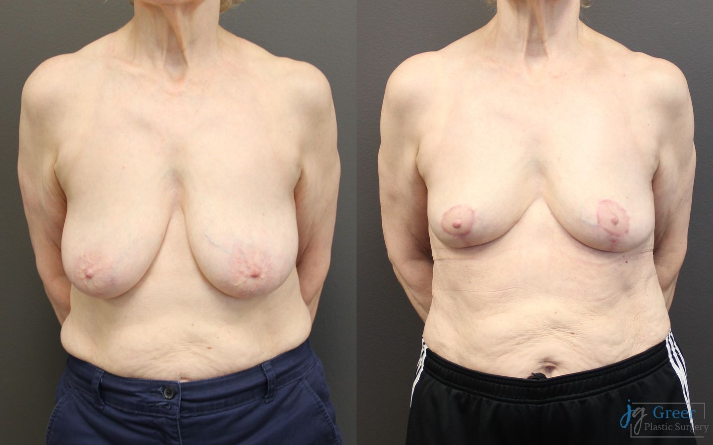Before and after Breast Reduction case 19793
