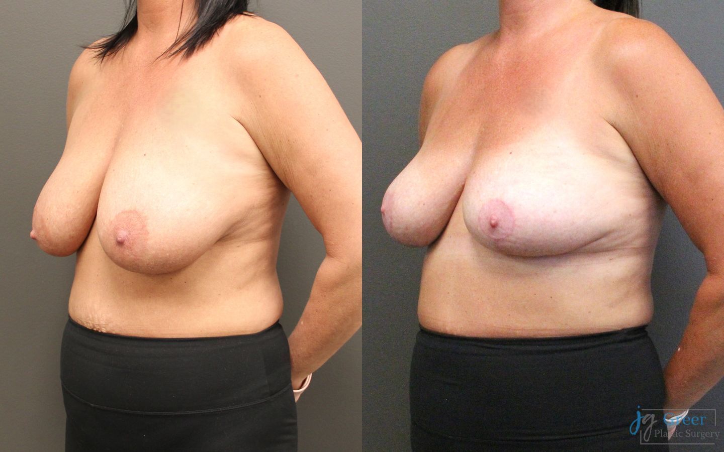 Before and after Breast Reduction case 21367 - Angle 2