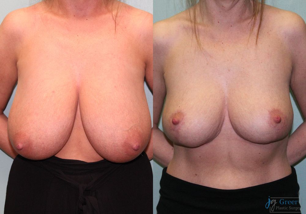 Breast Reduction - Case 2380