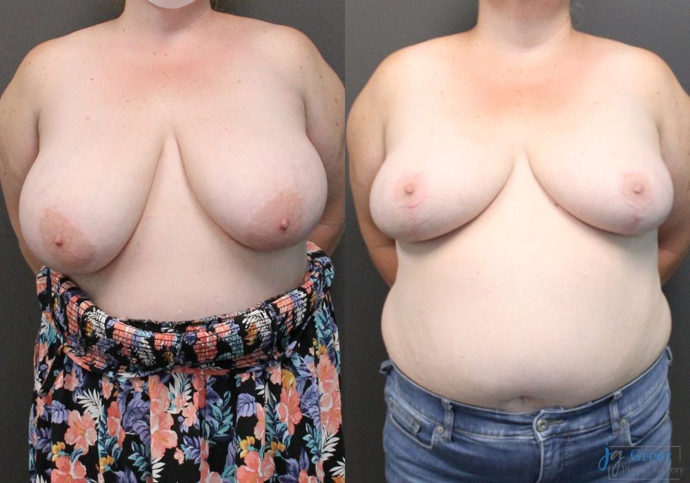 Breast Reduction - Case 2375