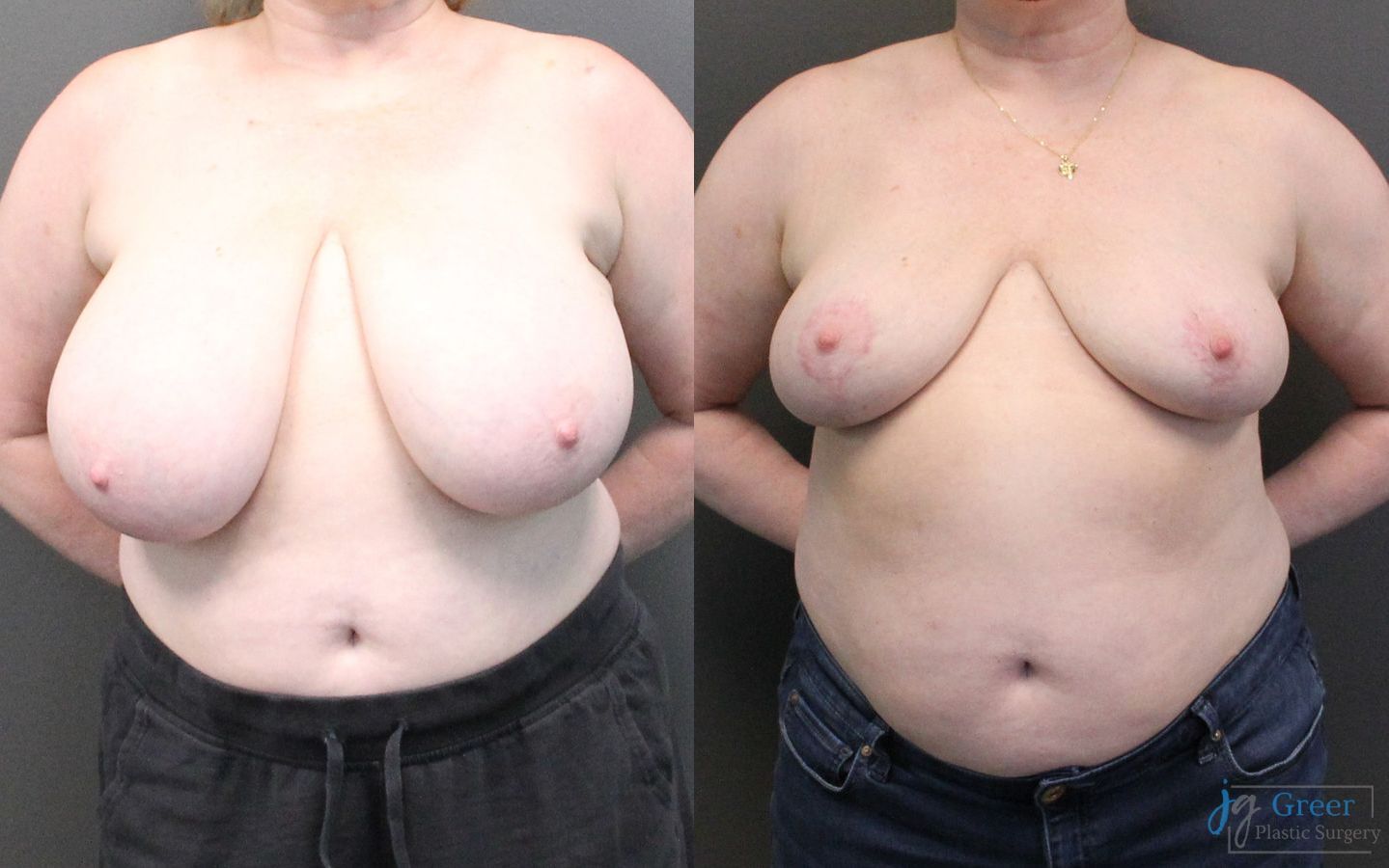 Before and after Breast Reduction case 19799