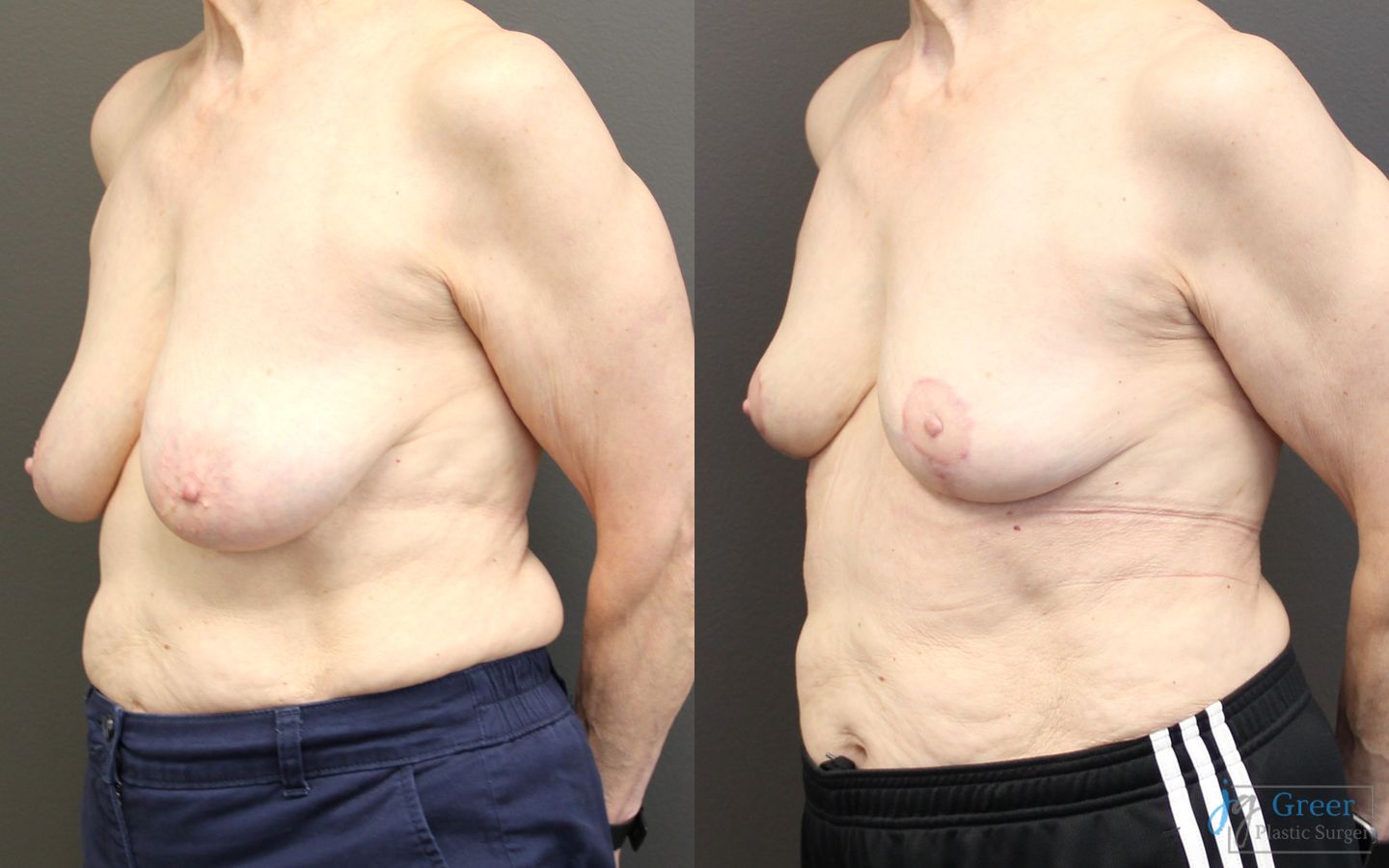Before and after Breast Reduction case 19793 - Angle 2