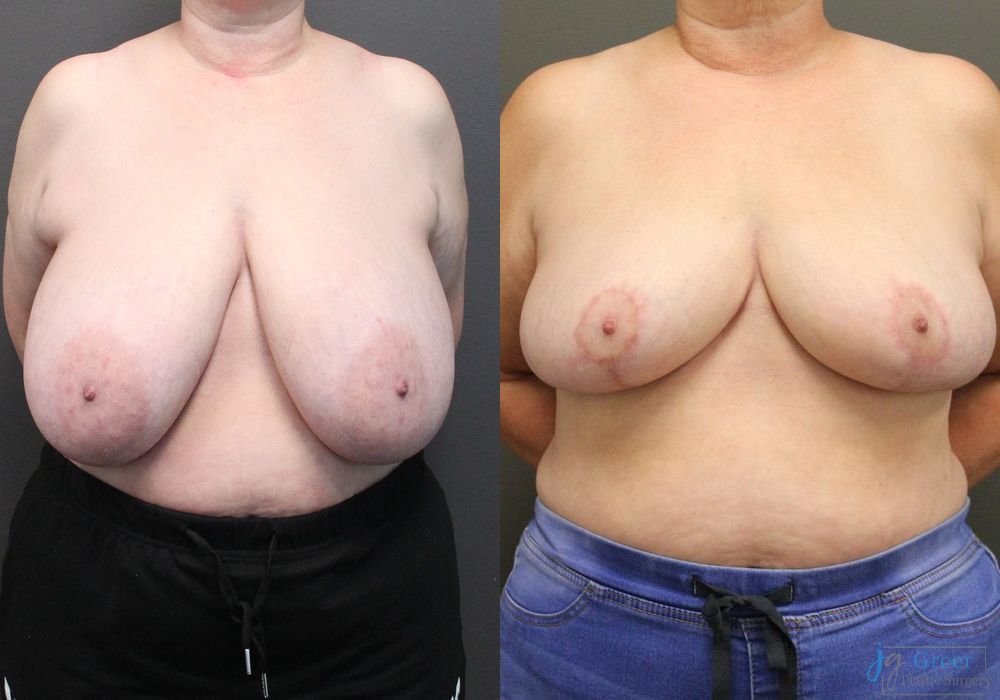 Breast Reduction - Case 2374