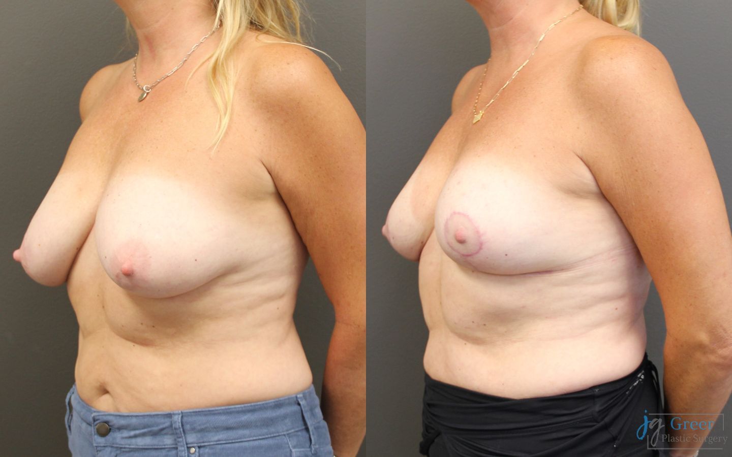 Before and after Breast Reduction case 19794 - Angle 2