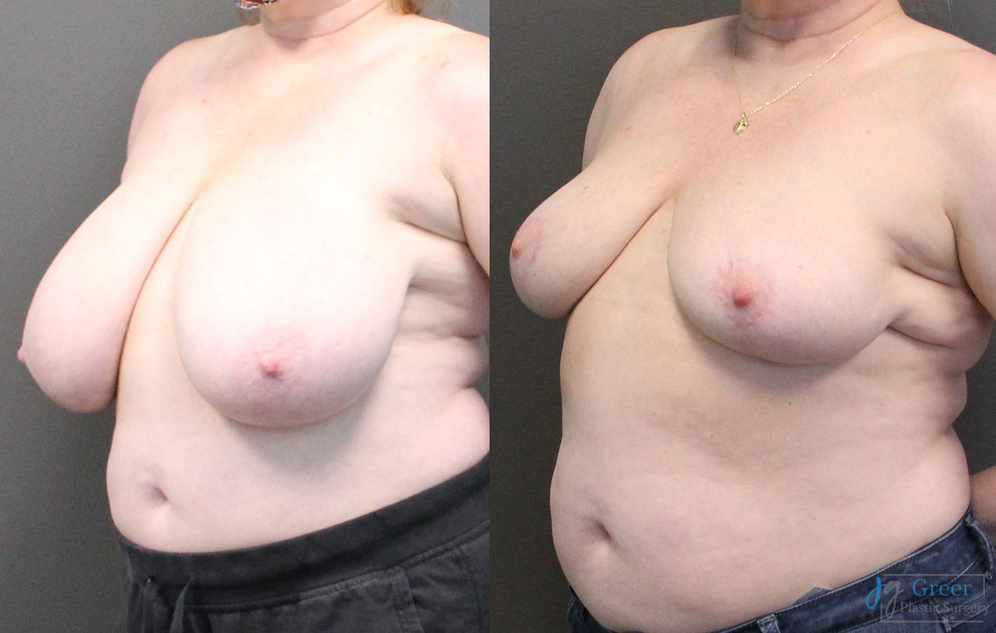 Before and after Breast Reduction case 19799 - Angle 2