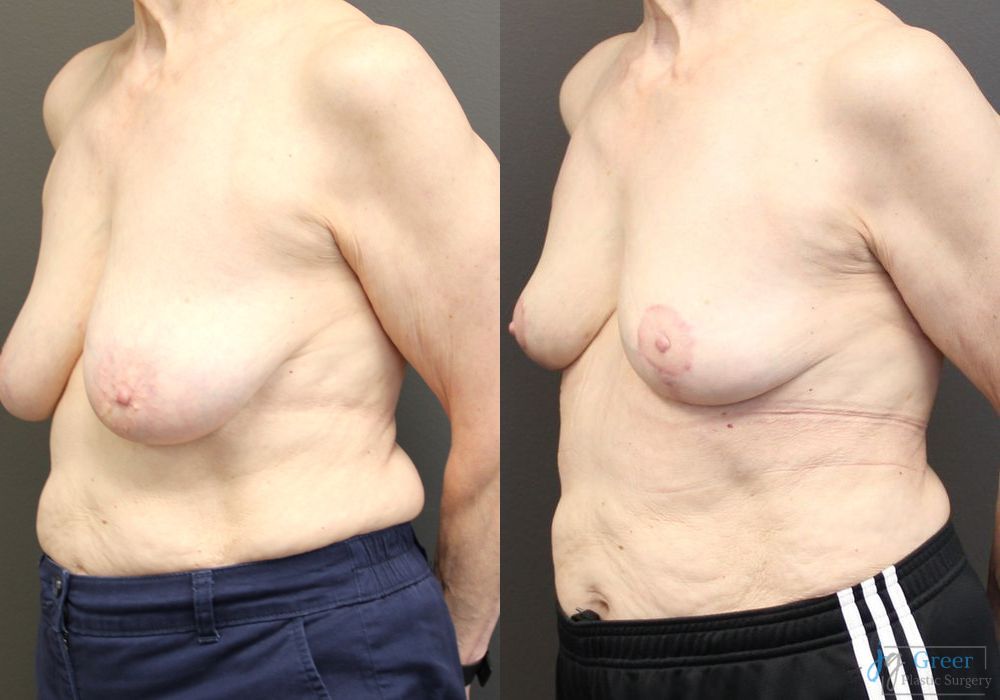 Breast Reduction - Thumbnail 2