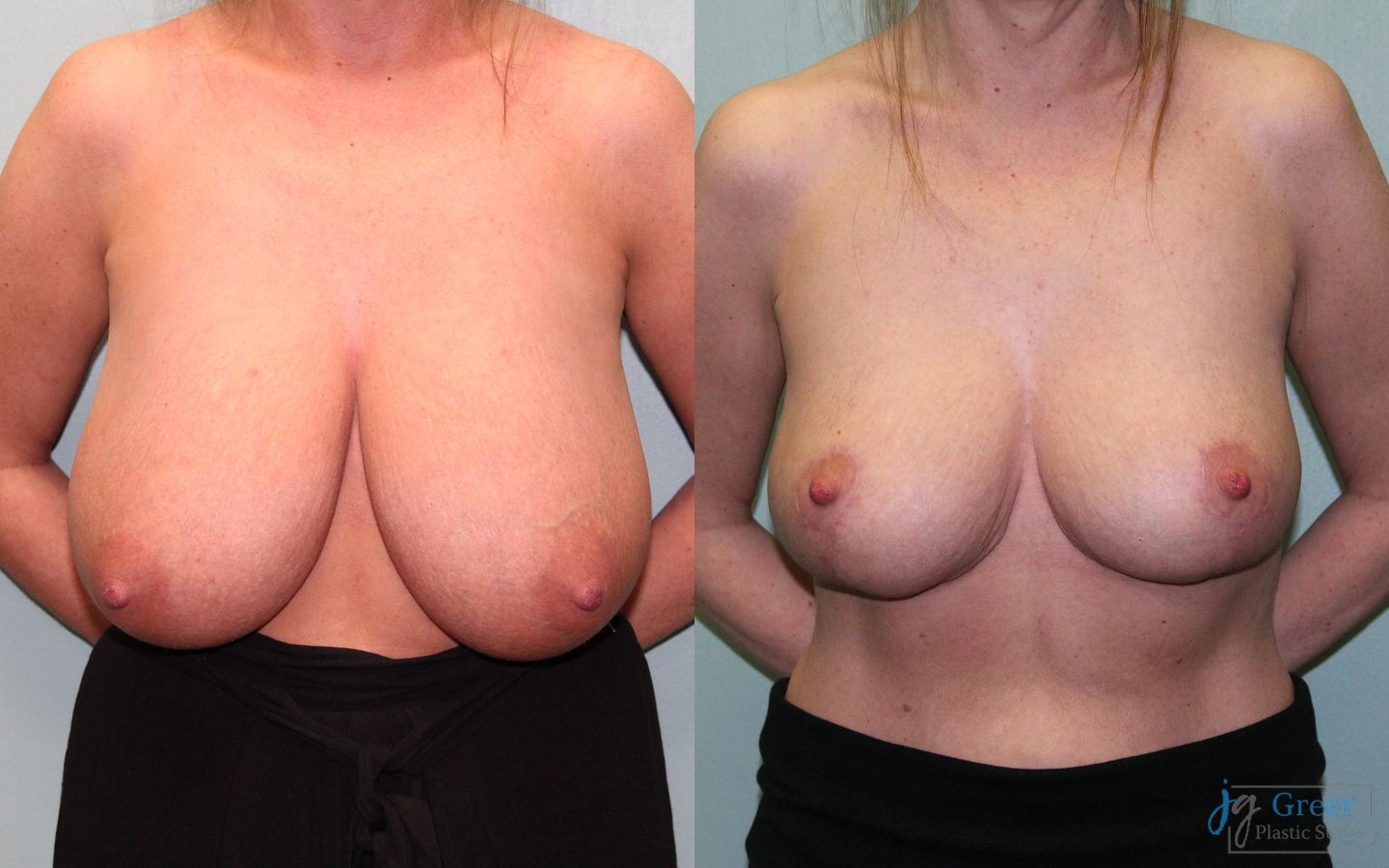Before and after Breast Reduction case 19804