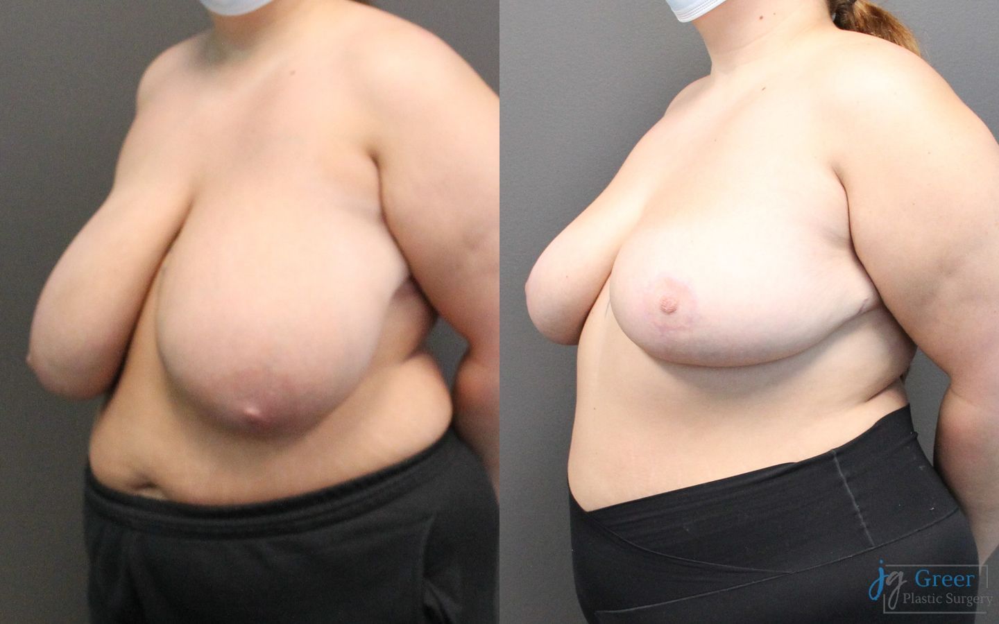 Before and after Breast Reduction case 19802 - Angle 2