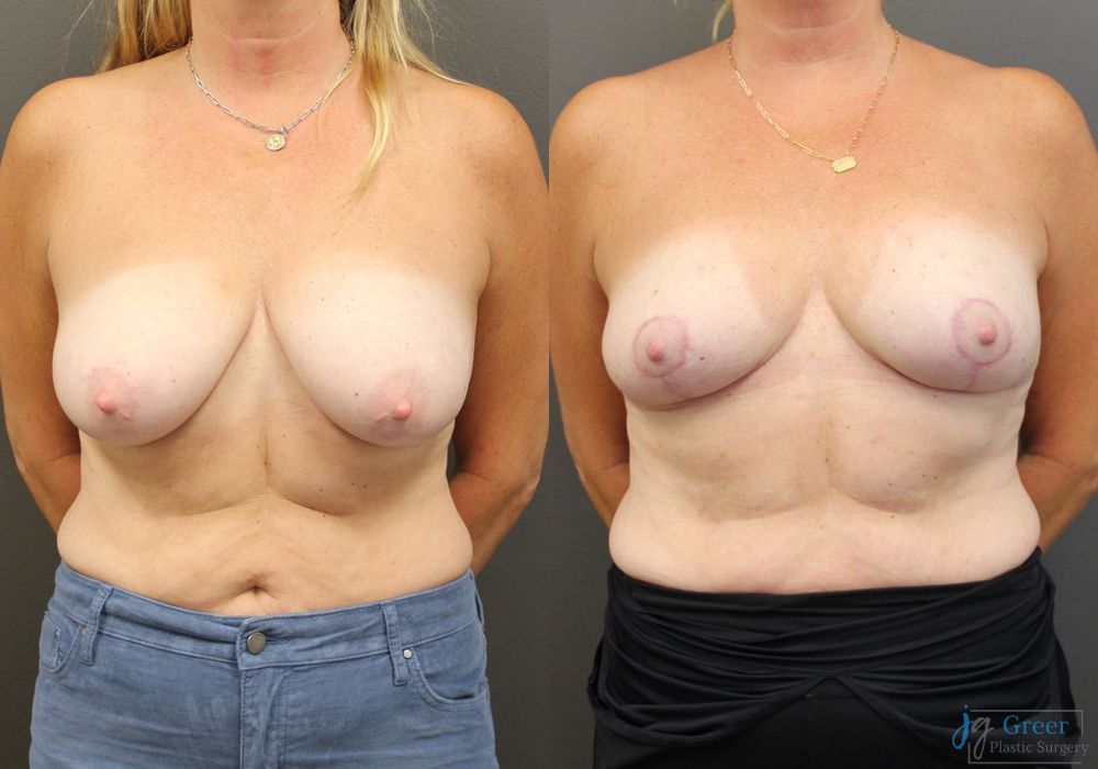 Breast Reduction - Case 2373