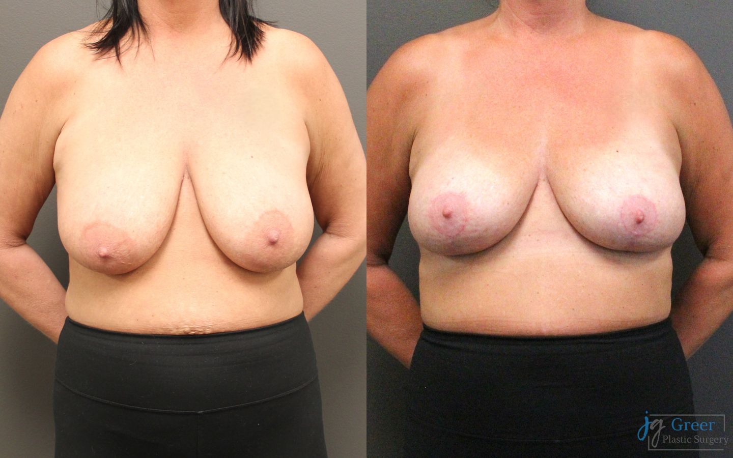 Before and after Breast Reduction case 21367