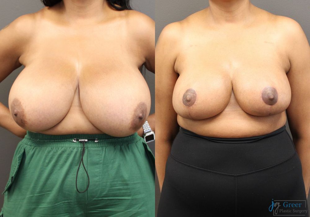 Breast Reduction - Case 2371