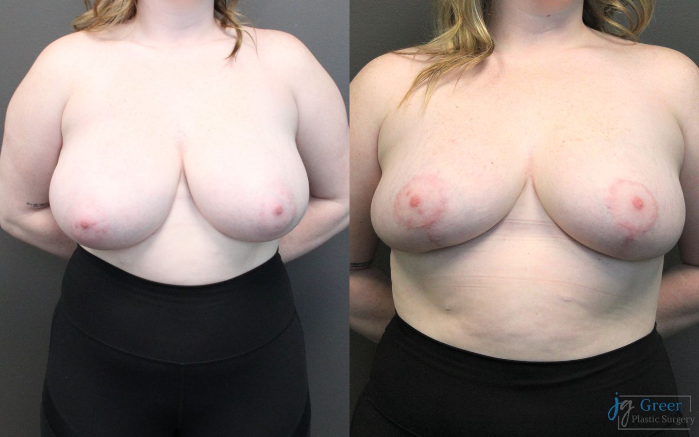 Before and after Breast Reduction case 19791