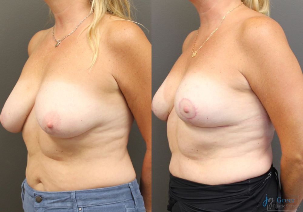 Breast Reduction - Thumbnail 2