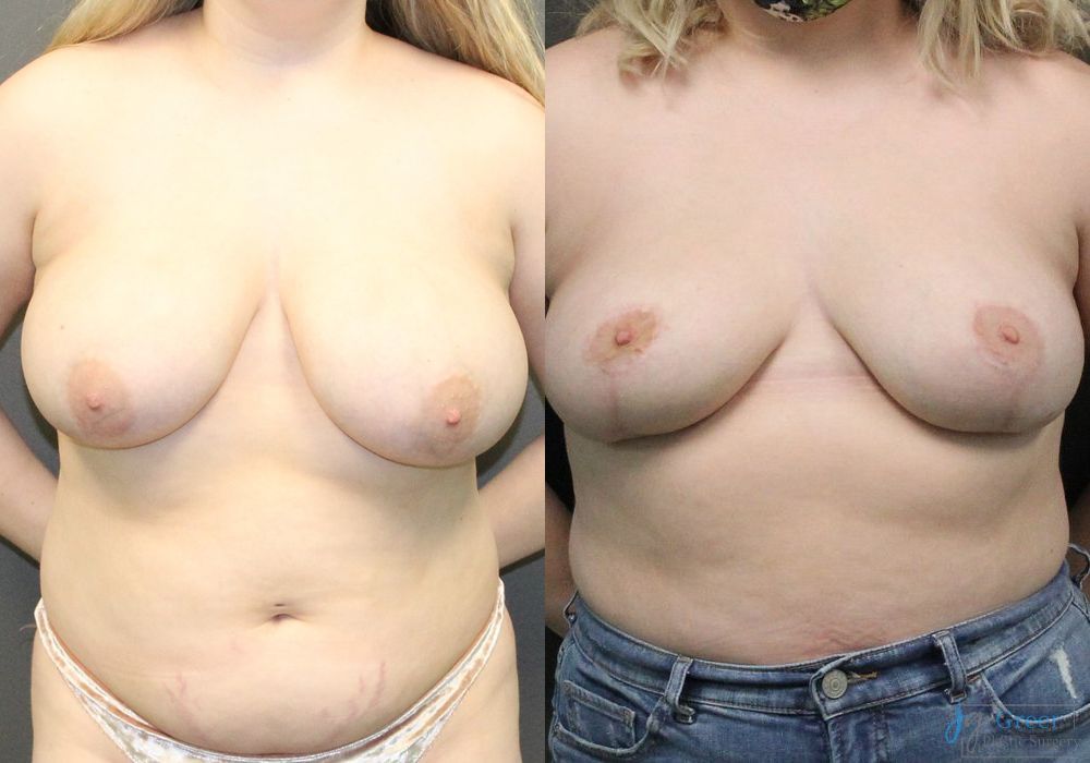 Breast Reduction - Case 2377