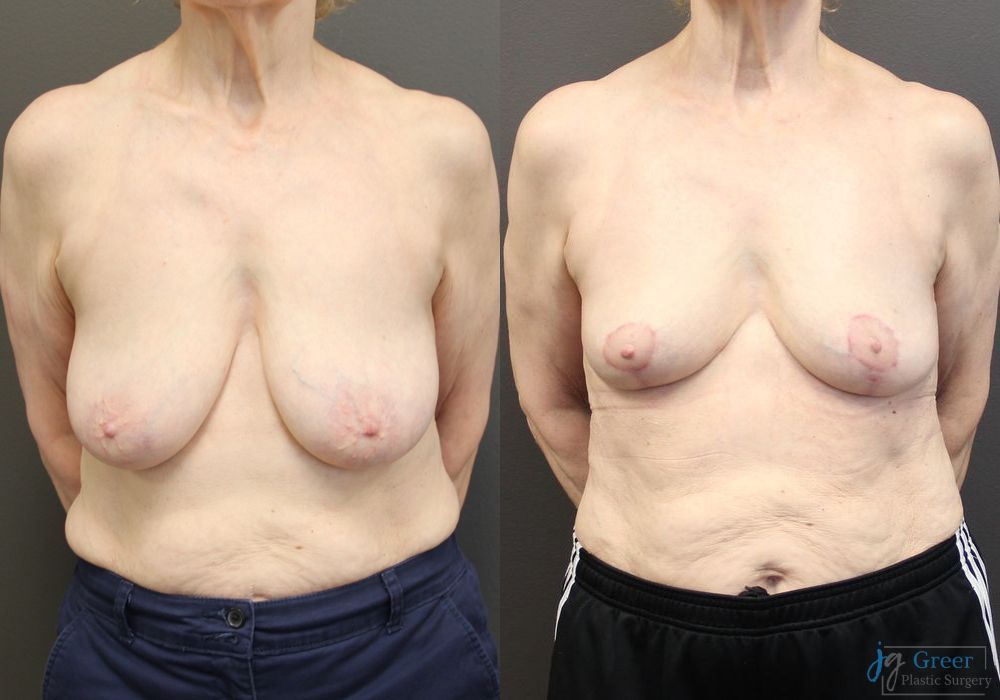 Breast Reduction - Case 2372