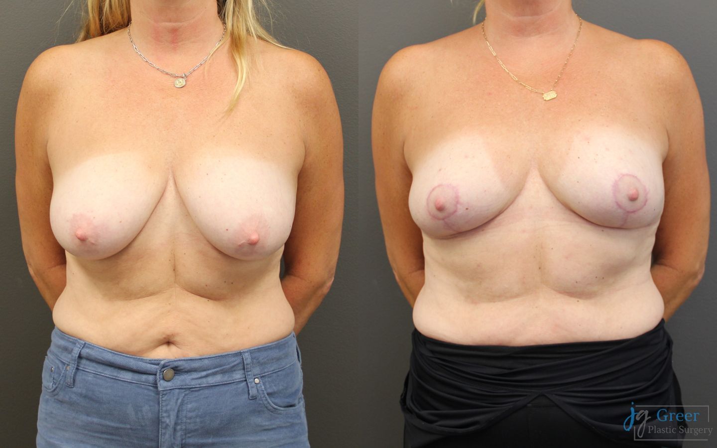 Before and after Breast Reduction case 19794
