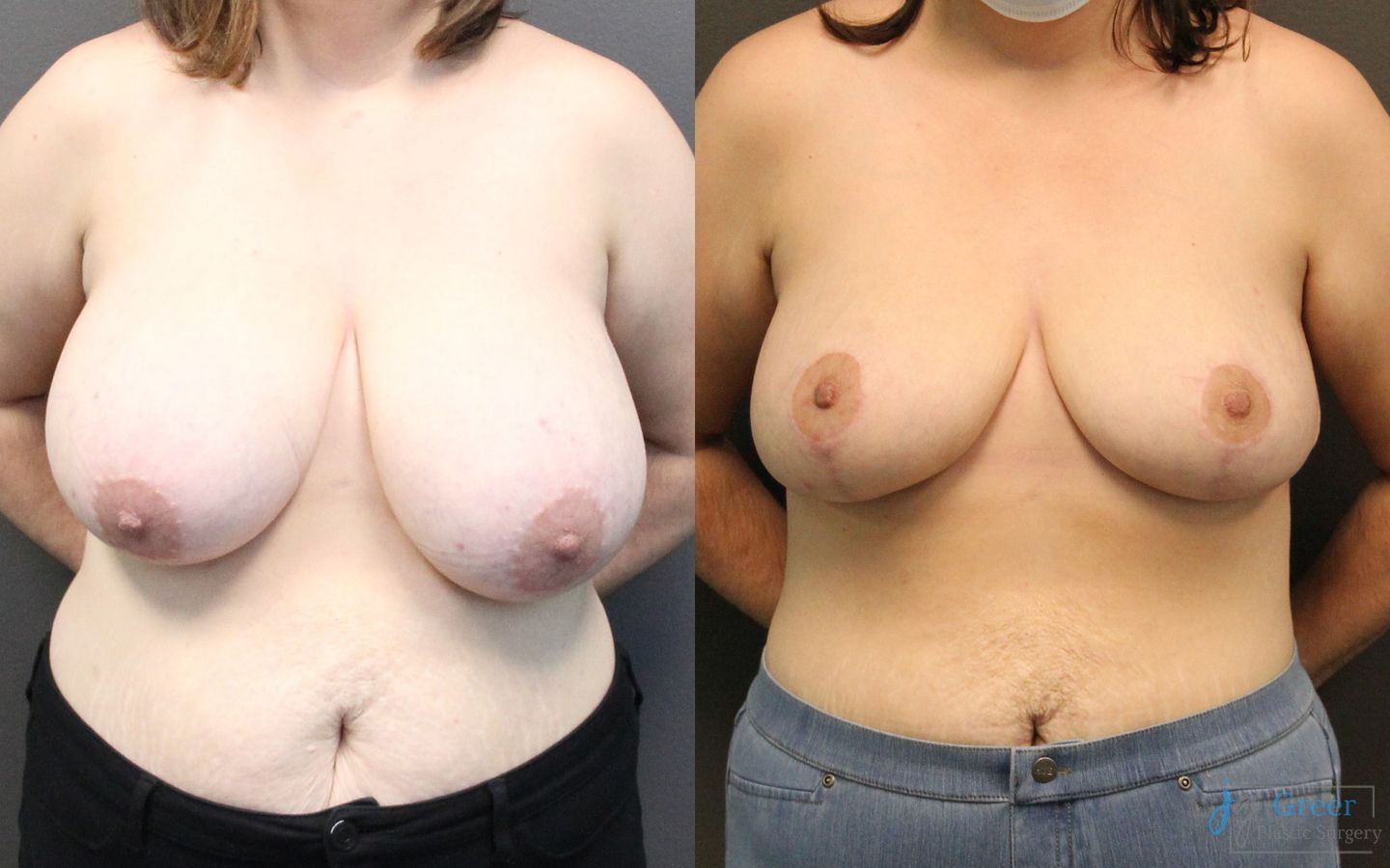 Before and after Breast Reduction case 19801