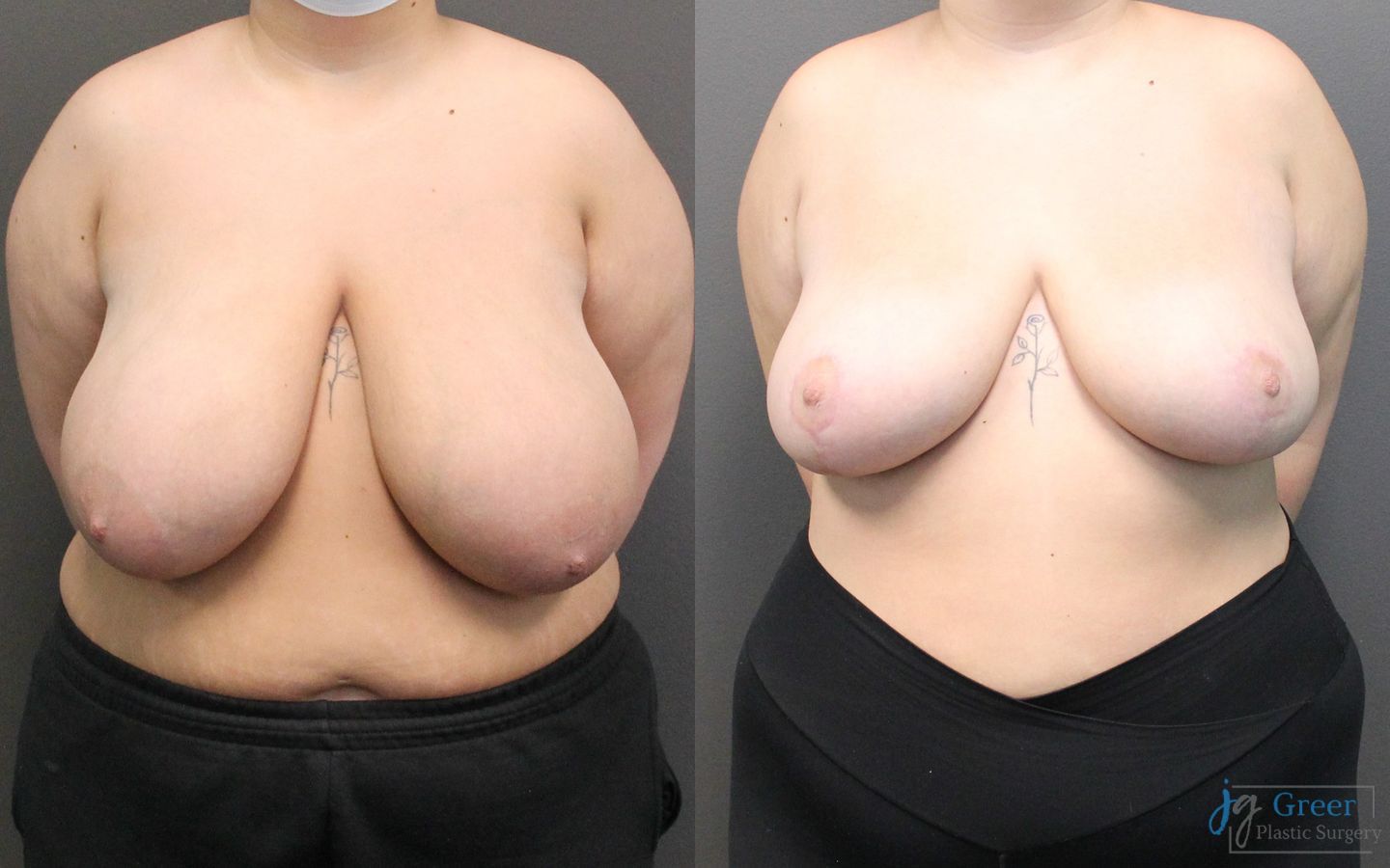 Before and after Breast Reduction case 19802