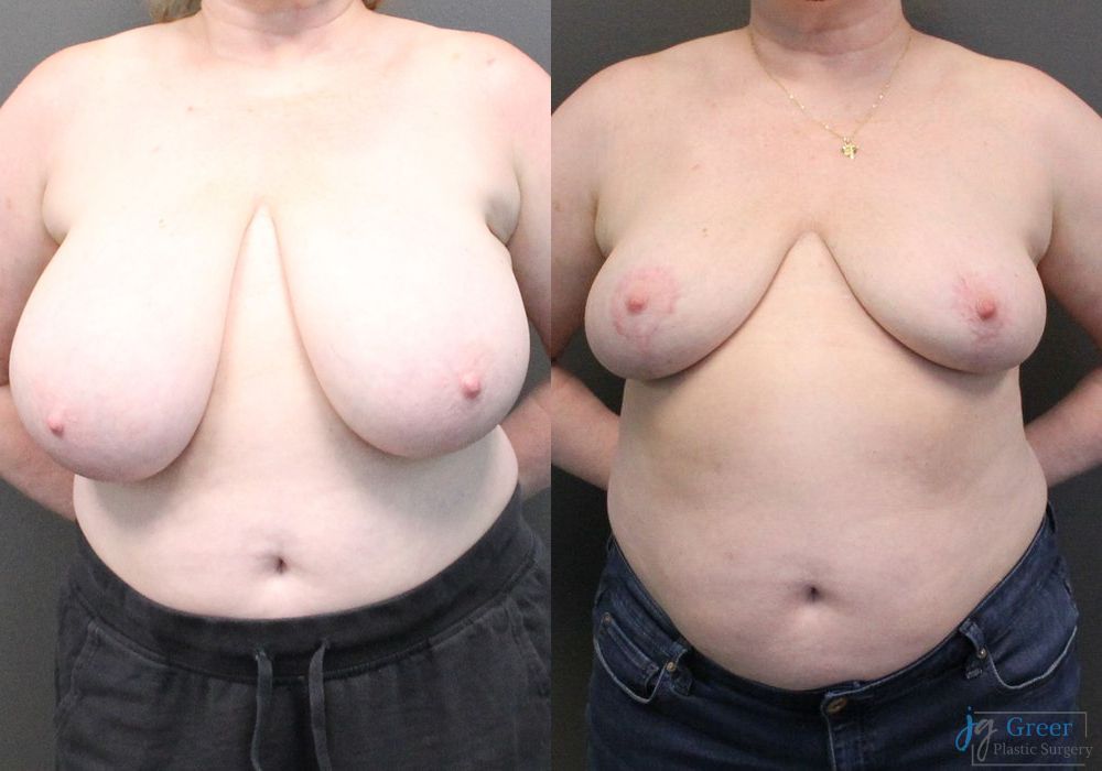 Breast Reduction - Case 2376