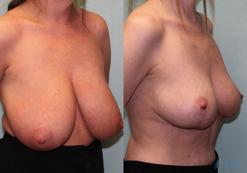 Breast Reduction - Thumbnail 2