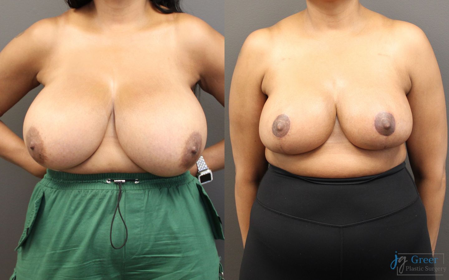 Before and after Breast Reduction case 19792