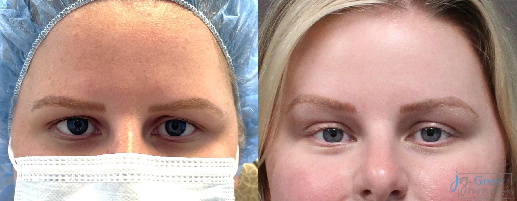 Brow Lift - Case 2403