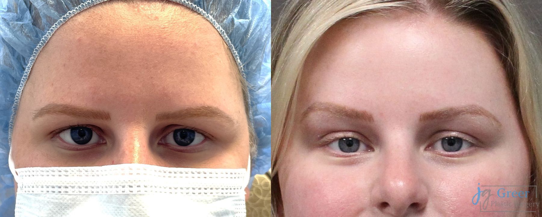 Before and after Brow Lift case 19884