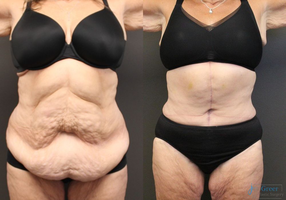 Fleur-de-Lis Abdominoplasty - Case 2657