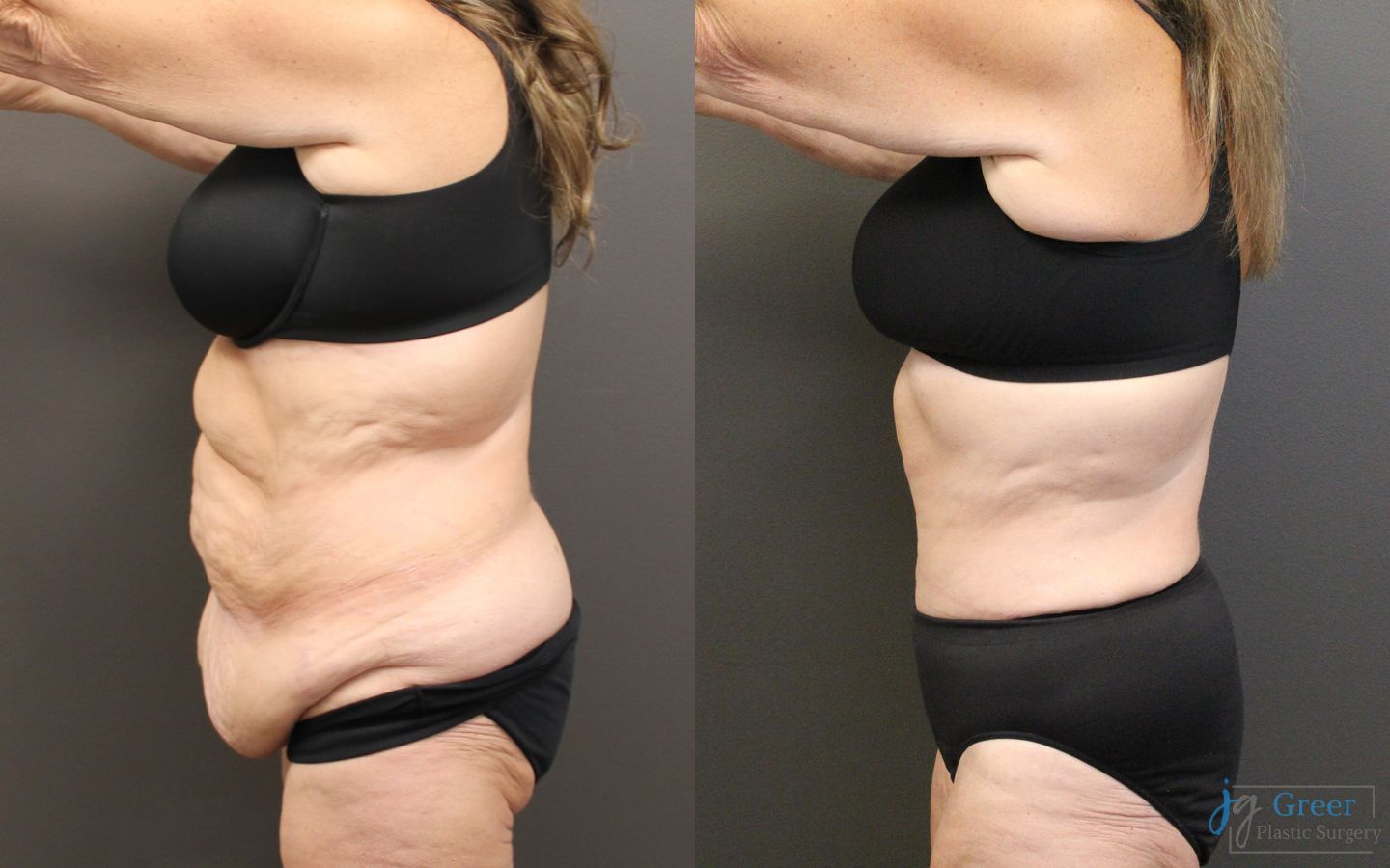 Before and after Fleur-de-Lis Abdominoplasty case 19864 - Angle 2