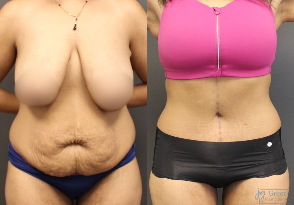 Fleur-de-Lis Abdominoplasty - Case 2314