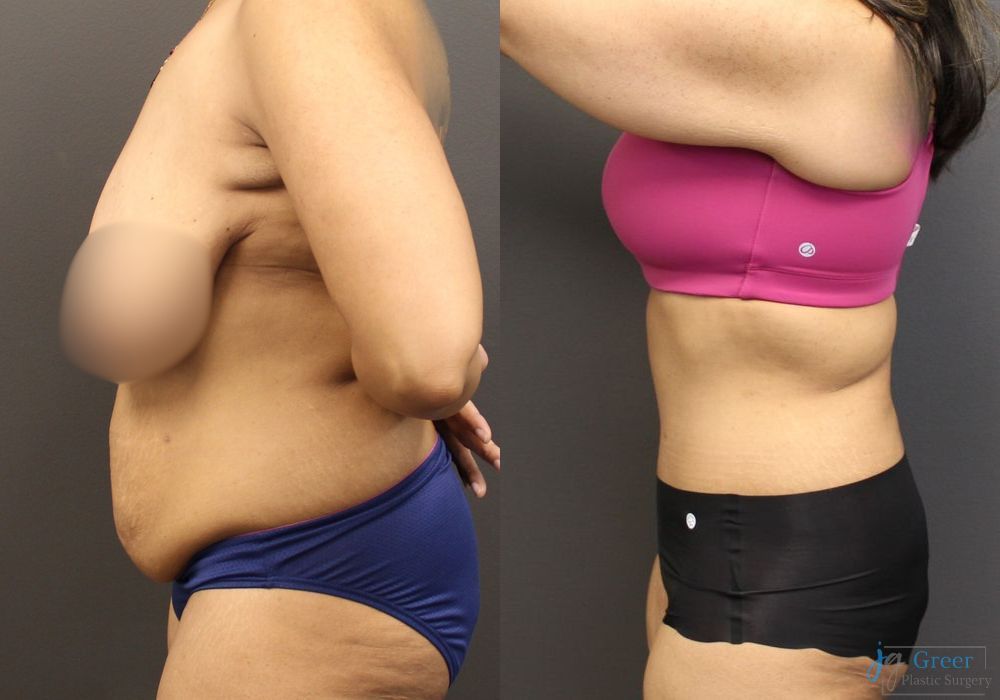 Fleur-de-Lis Abdominoplasty - Thumbnail 2