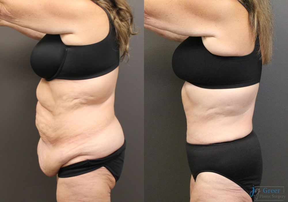 Fleur-de-Lis Abdominoplasty - Thumbnail 2