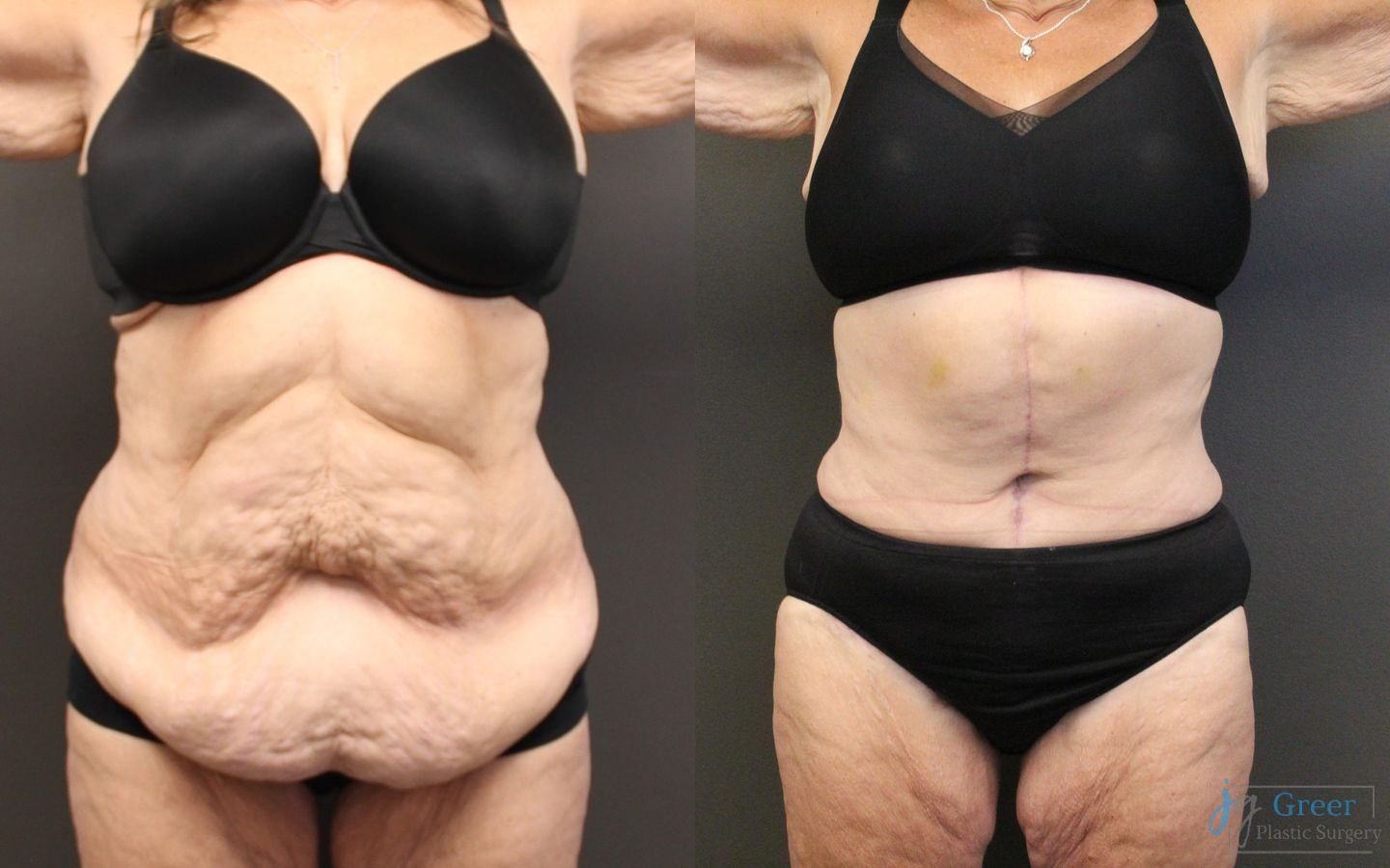 Before and after Fleur-de-Lis Abdominoplasty case 19864