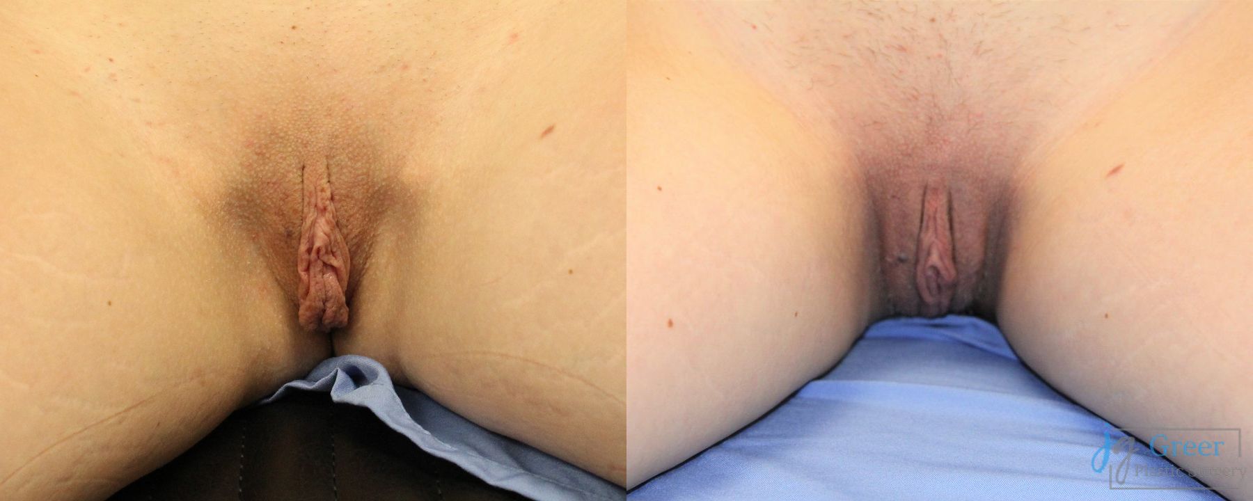 Before and after Labiaplasty case 19895