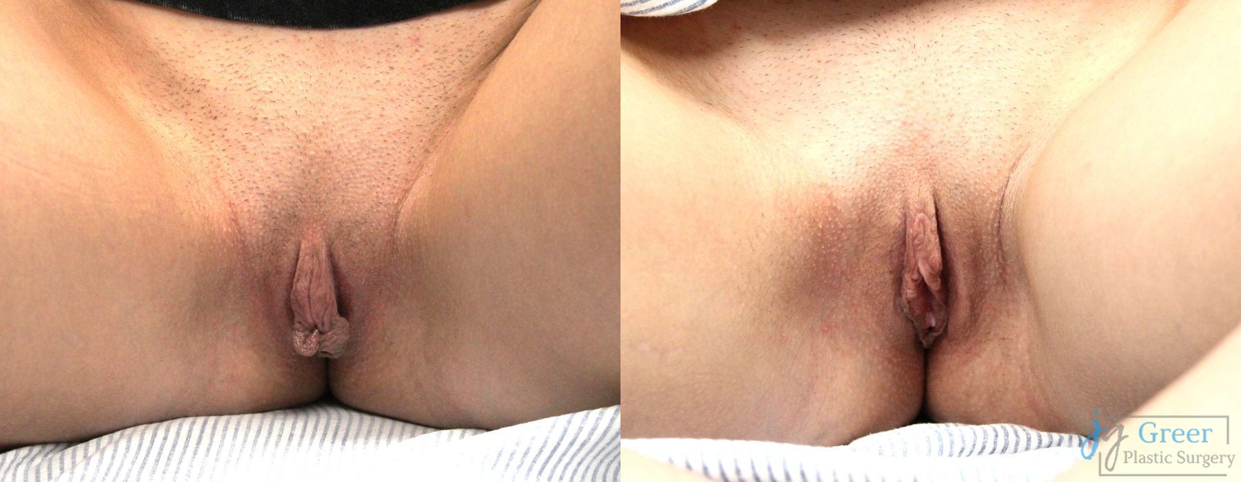 Labiaplasty - Case 2316