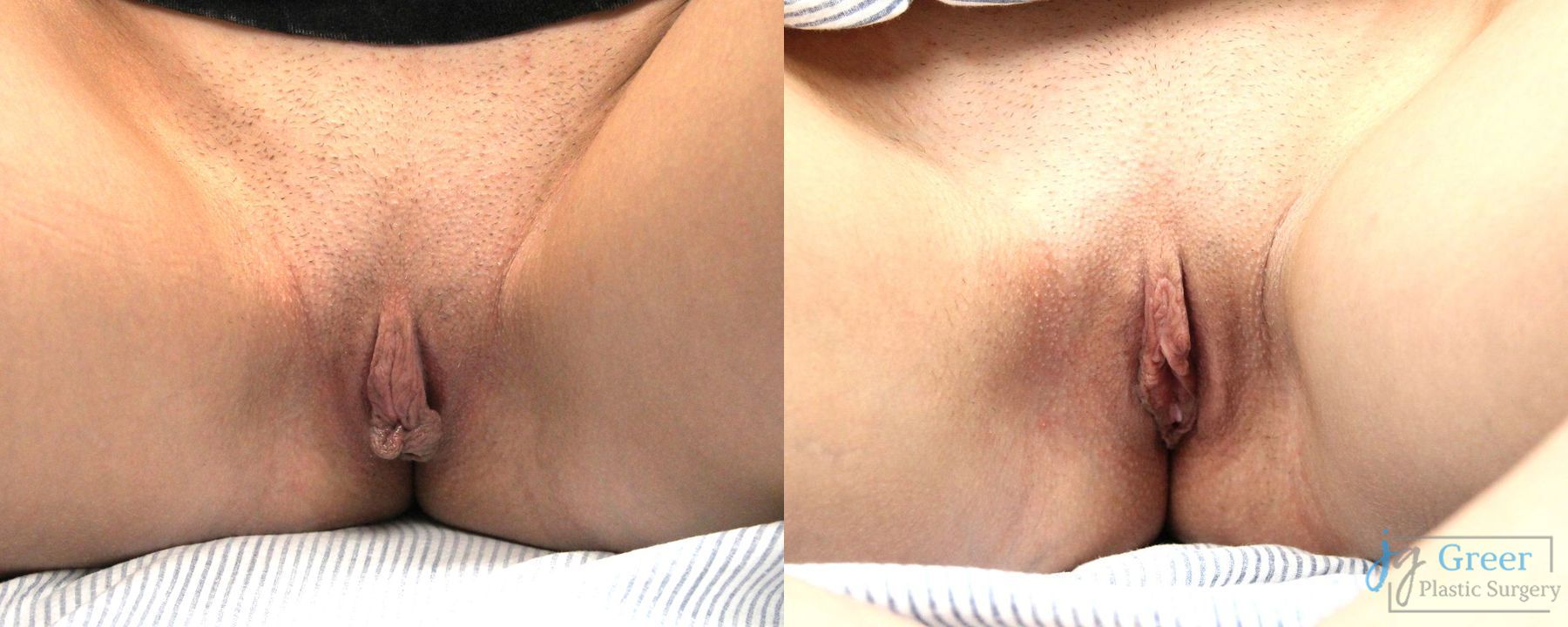 Before and after Labiaplasty case 19894