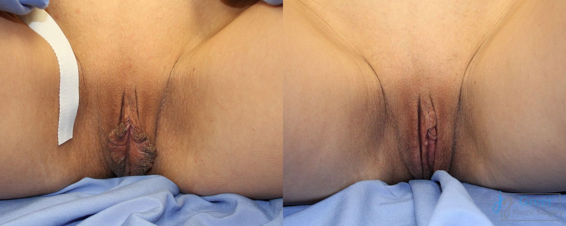 Before and after Labiaplasty case 41338